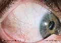 Right Lateral Sclera