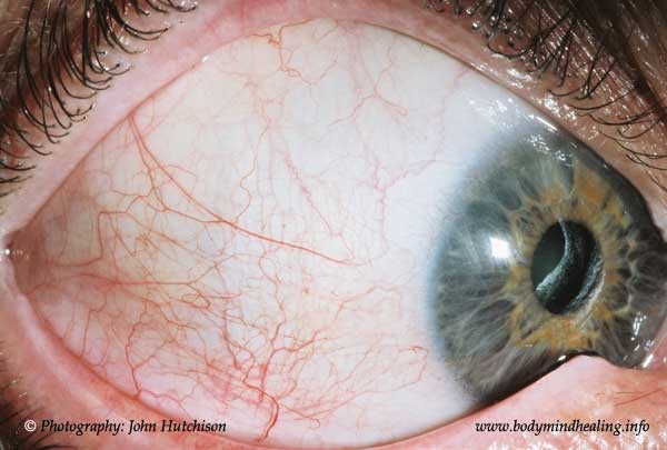 Right Lateral Sclera